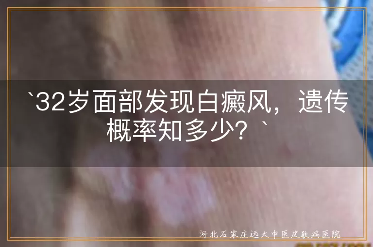 白癜风,遗传概率,多因素性,专业治疗,心态调整