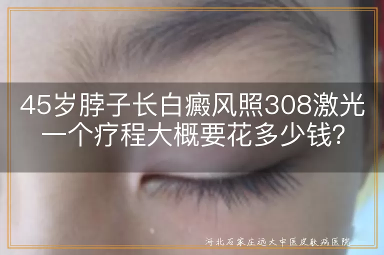 白癜风,308激光治疗,费用,正规医院,生活习惯