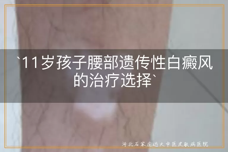 遗传性白癜风,儿童治疗,药物治疗,光疗,手术治疗,日常护理,防晒,心理疏导
