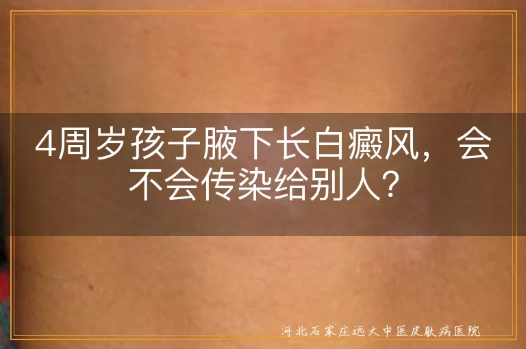 白癜风,传染,儿童,治疗,关爱,支持