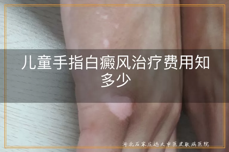 儿童白癜风,治疗费用,病情严重程度,治疗方法,正规医院,医疗保险