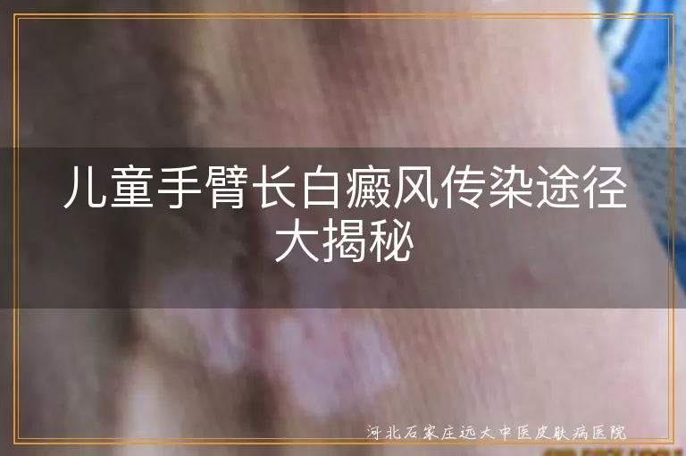 白癜风,不传染,儿童,黑色素细胞,治疗,心理健康,遗传,外伤,日晒,情绪因素