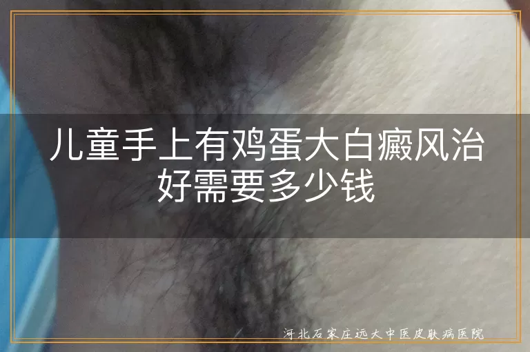 儿童白癜风,治疗费用,病情严重程度,治疗方法,地区医疗水平,医院级别,医疗保险,日常护理