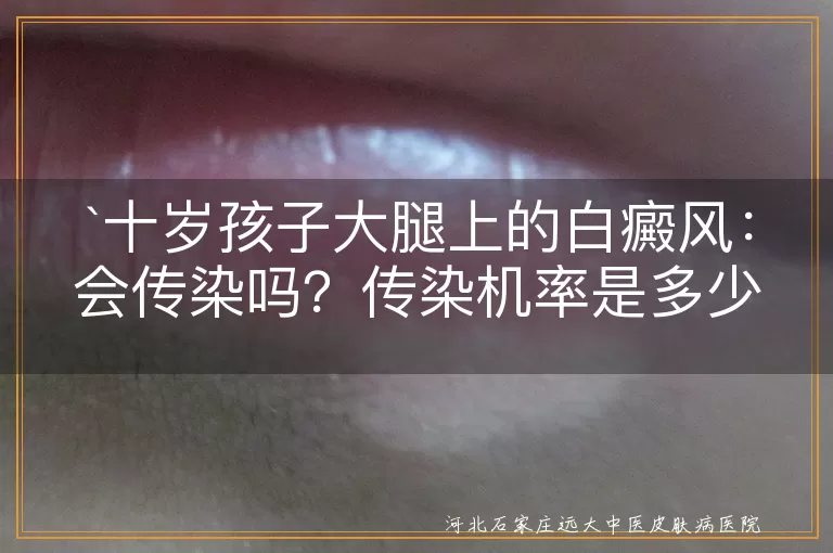 白癜风,传染病,遗传,治疗,心理健康,防晒,饮食均衡,心理疏导
