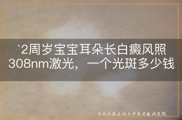 2周岁宝宝,白癜风,308nm激光,光斑价格,治疗费用,安全性,专业医生,正规医院