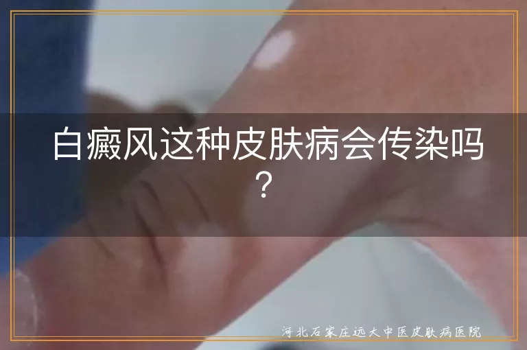 白癜风,传染性,遗传,免疫系统失调,治疗方法,预防
