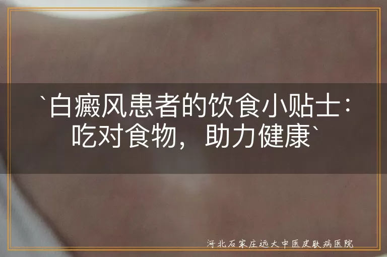 白癜风,饮食调整,均衡营养,避免刺激,多喝水,微量元素,饮食习惯