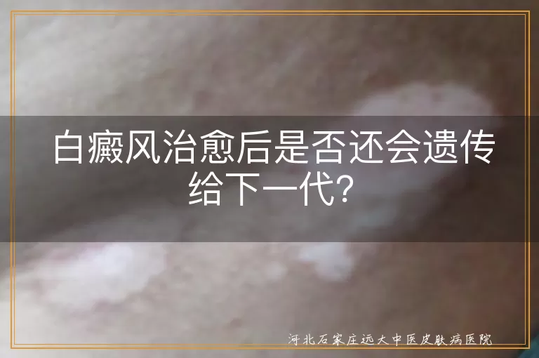 白癜风,遗传,下一代,多基因疾病,易感基因,生活方式,情绪状态,治疗态度