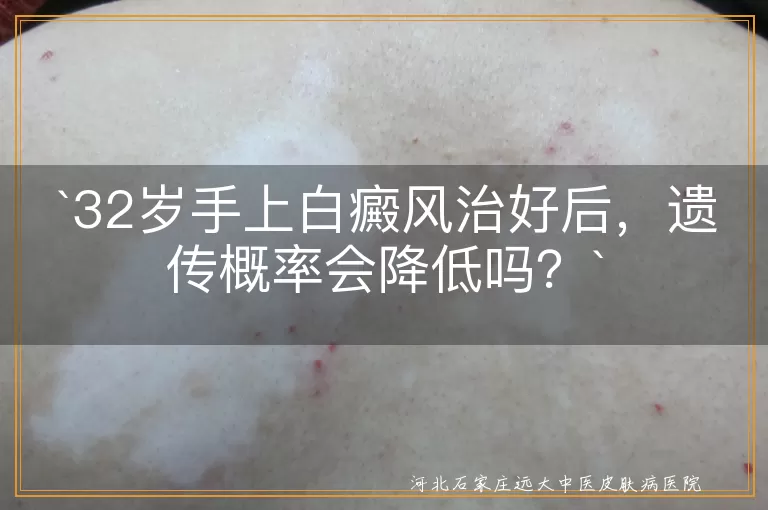 白癜风,遗传概率,降低风险,健康生活,防止复发