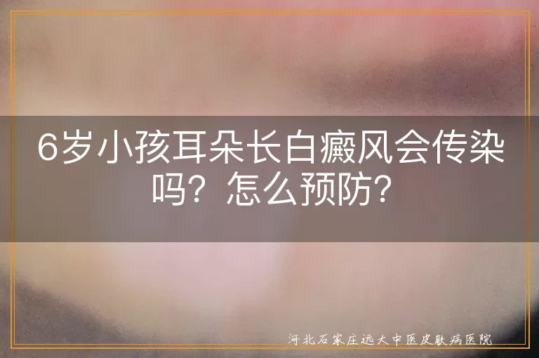 白癜风,传染,预防,儿童,治疗