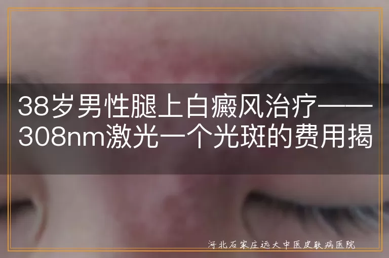 308nm激光,白癜风,治疗费用,光斑,医院级别,白斑面积