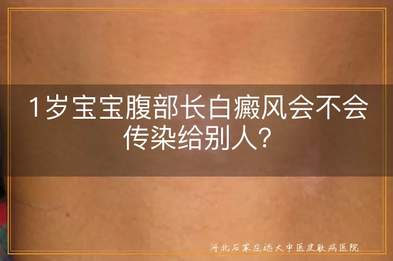 白癜风,不传染,遗传因素,环境因素,治疗,护理,免疫力
