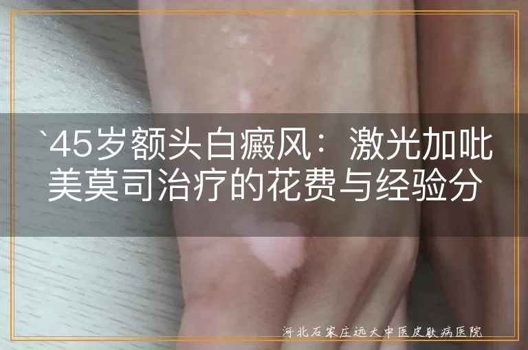 `白癜风,激光治疗,吡美莫司软膏,治疗费用,经验分享`