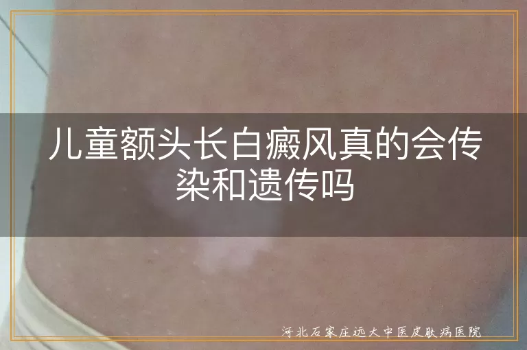 白癜风,儿童,额头,传染,遗传,治疗,自身免疫,神经精神因素