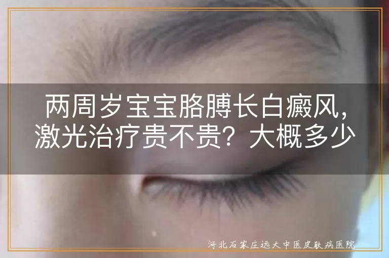 两周岁宝宝,白癜风,激光治疗,费用,正规医院,防晒,饮食调整