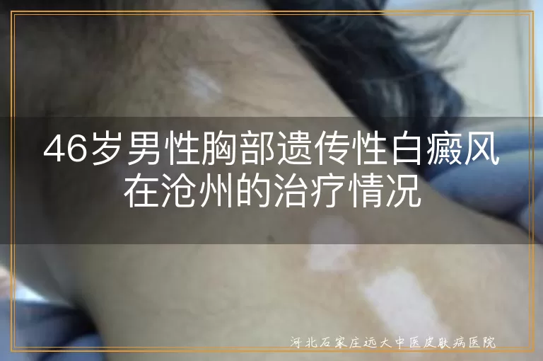 遗传性白癜风,沧州治疗,药物治疗,物理治疗,手术治疗,防晒,饮食调理,心理调适