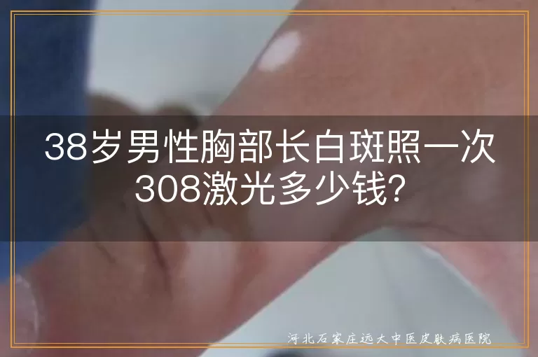 308激光治疗,白癜风,费用,医院级别,地区差异,设备类型,治疗仪价格