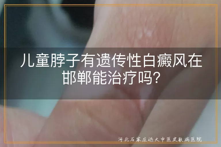 儿童白癜风,遗传性,邯郸治疗,个性化方案,心理疏导,家长配合