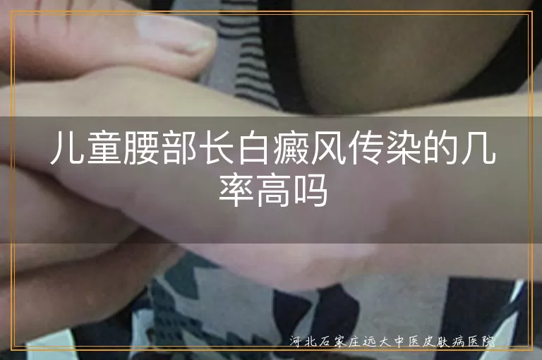 白癜风,儿童,腰部,传染性,遗传性,预防,护理