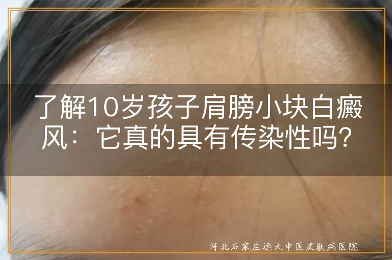白癜风,传染性,儿童,色素脱失,治疗,心理因素,遗传因素