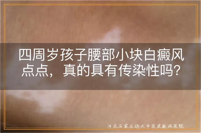 白癜风,传染性,儿童,腰部白斑,科学治疗,心理关怀