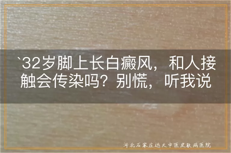 白癜风,皮肤病,非传染病,黑色素细胞,治疗,不传染
