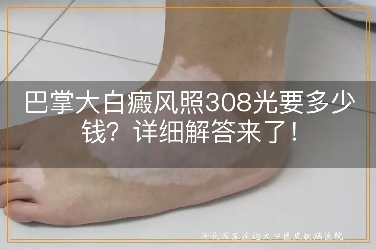 白癜风,308光治疗,治疗费用,影响因素,节省费用方法,注意事项