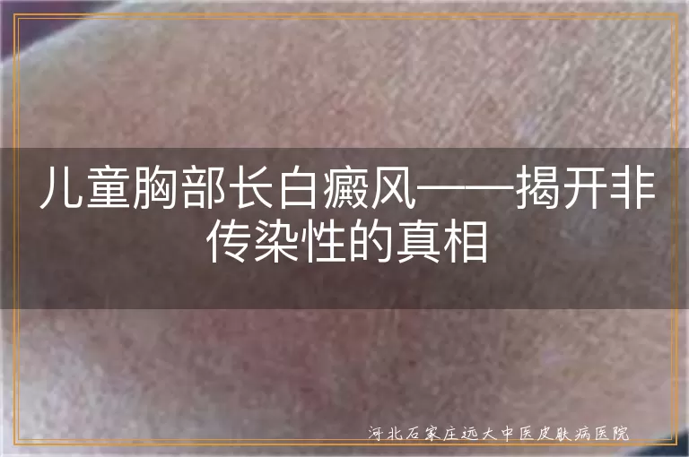 儿童白癜风,传染性,遗传因素,自身免疫,外伤,情绪压力,家长关怀,治疗方案