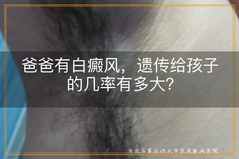 白癜风,遗传几率,自身免疫,环境因素,预防治疗