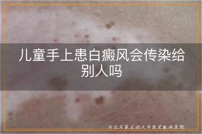 儿童白癜风,传染性,治疗,预防,心理影响