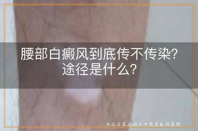 白癜风,传染,途径,症状,治疗,预防