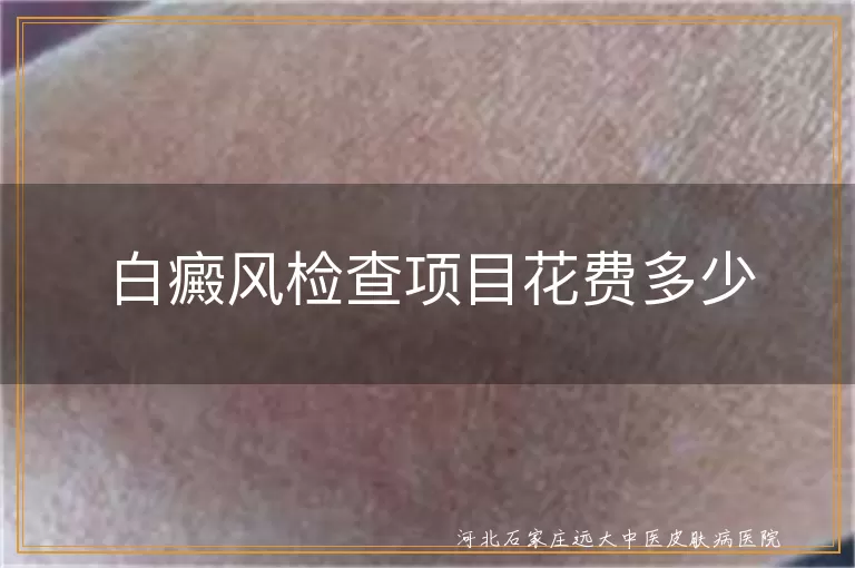 白癜风,检查项目,费用,皮肤镜检查,血常规检查,Wood灯检查,治疗费用