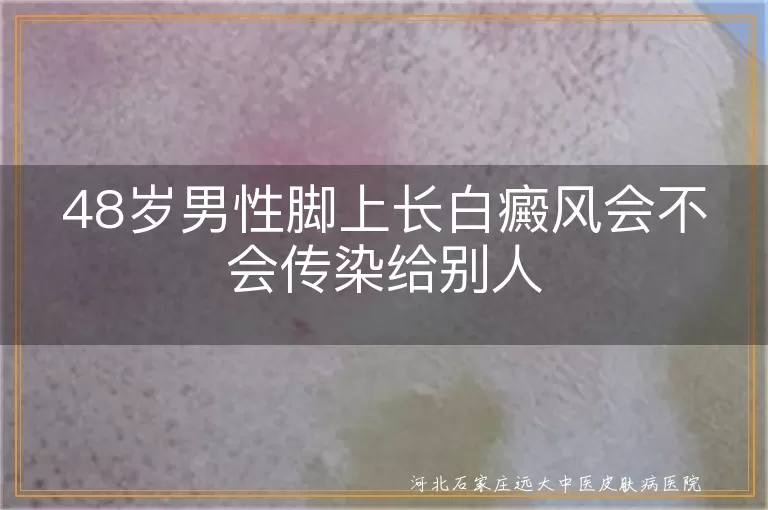 白癜风,传染,治疗,预防,心理健康