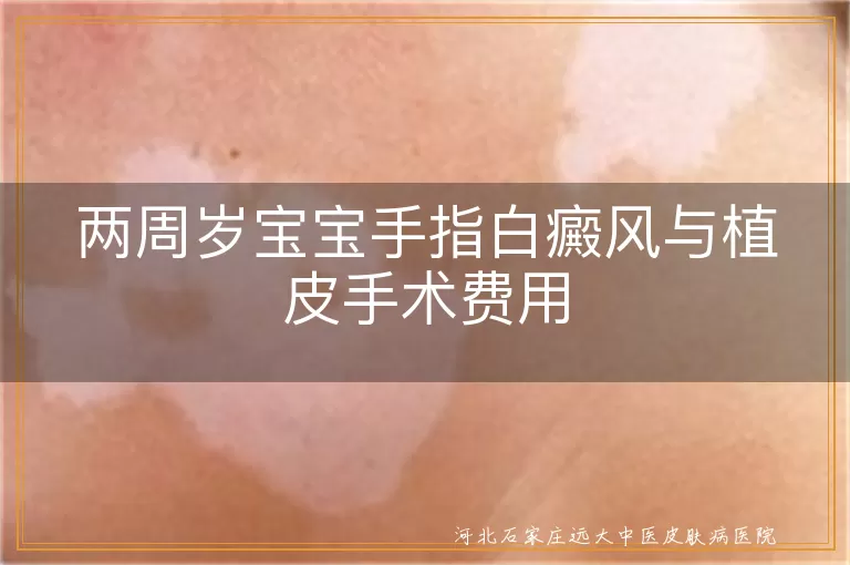 两周岁宝宝白癜风植皮手术费用, 白癜风植皮手术多少钱, 白癜风植皮手术费用估算, 白斑植皮手术费用