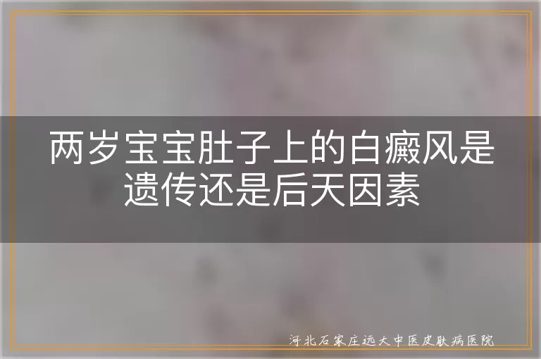 两岁宝宝白癜风遗传因素, 后天因素白癜风, 宝宝白癜风诊断治疗, 白癜风预防护理