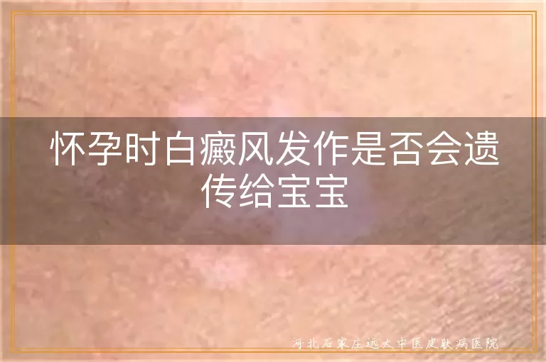 白癜风遗传风险,怀孕白癜风遗传,白癜风宝宝护理,白癜风家族病史