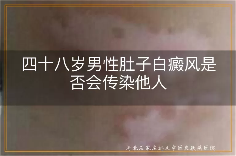 白癜风传染性,白癜风患者注意事项,白癜风治疗方法,白癜风心理关怀