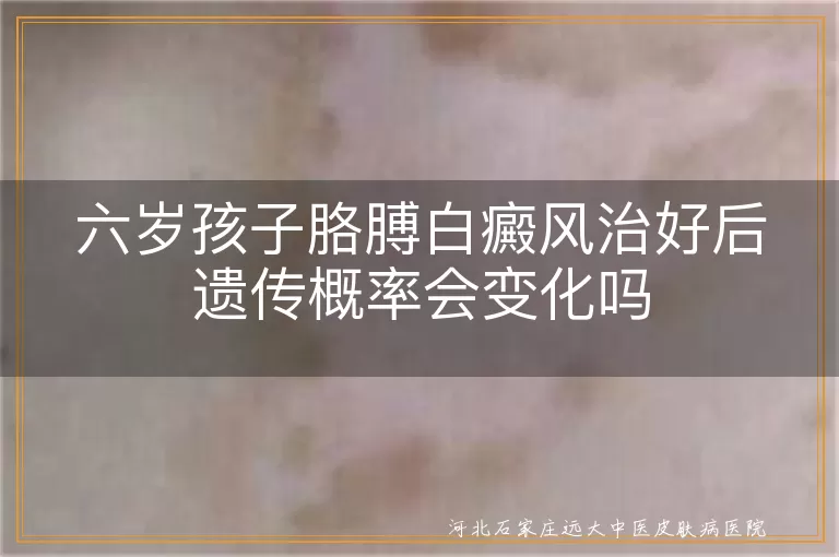 白癜风遗传概率,儿童白癜风治疗,白癜风发病因素,降低白癜风风险