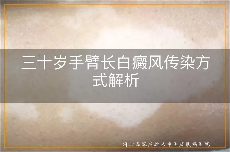 白癜风扩散原因,白癜风预防方法,白斑如何控制,白斑非传染性