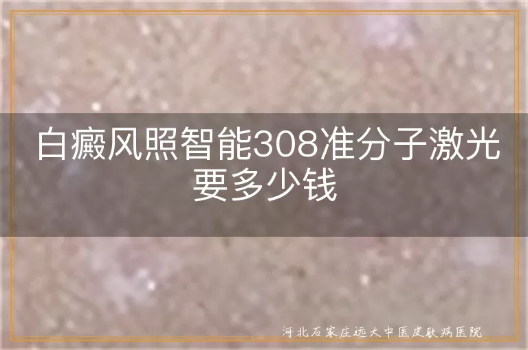 白癜风照智能308准分子激光费用, 白斑激光治疗价格, 白癜风308激光治疗成本, 白斑病激光治疗开销