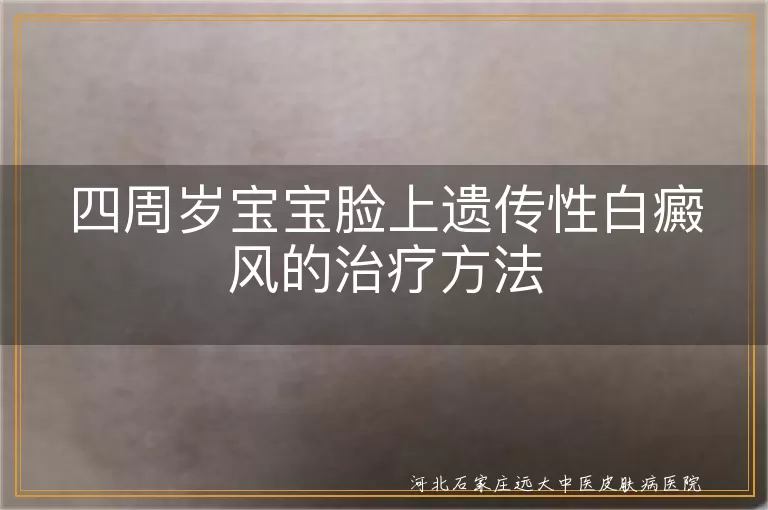 四周岁宝宝遗传性白癜风治疗,宝宝白斑治疗方法,儿童白癜风康复方法,遗传性白癜风治疗策略