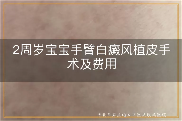 2周岁宝宝白癜风植皮手术费用, 宝宝白斑植皮治疗, 白癜风植皮手术多少钱, 白斑治疗费用