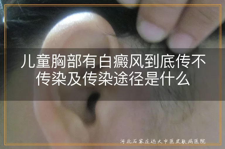 儿童胸部白癜风传染途径,白斑病传染问题,白癜风传染误解,儿童白癜风诱因