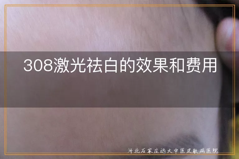 308激光祛白效果,白癜风治疗费用,白斑308激光祛白,308激光祛白价格