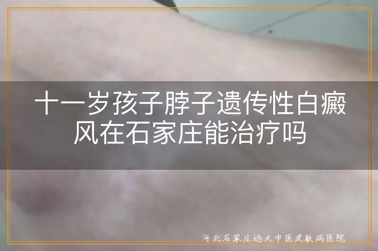 儿童遗传性白癜风治疗,石家庄白癜风医院,白斑专业治疗,遗传性白斑康复