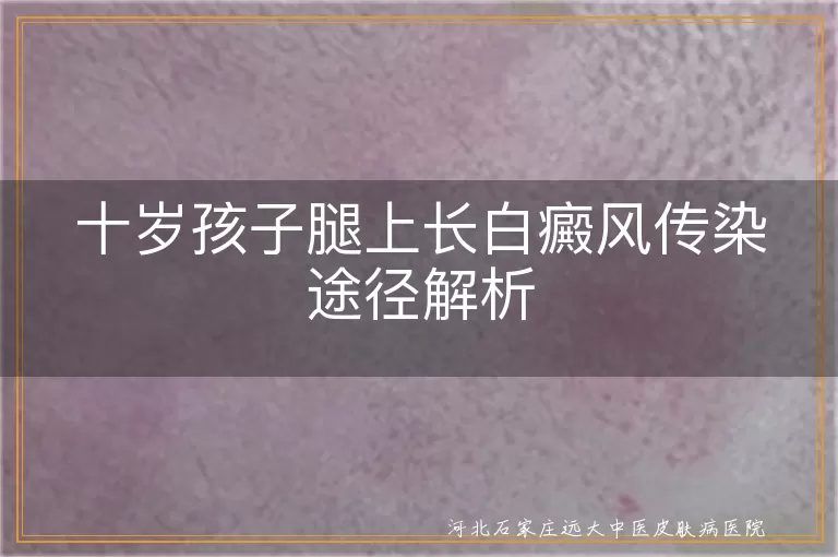 孩子白癜风传染误区,白癜风非传染性疾病,儿童白斑病因解析,白斑病预防与治疗