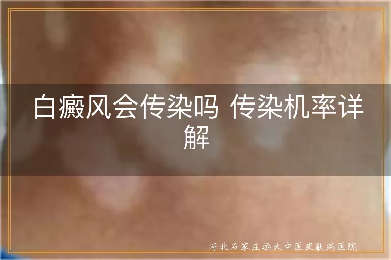 白癜风传染机率,白斑病因,白癜风非传染病,白癜风日常护理