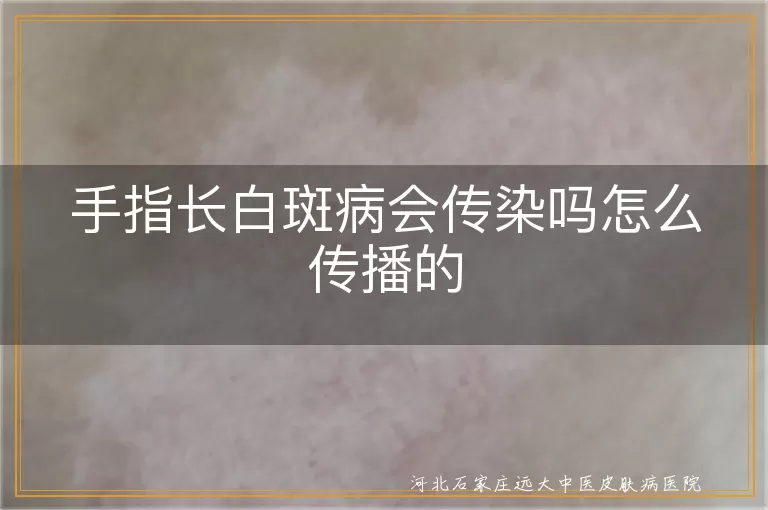 手指白斑病不会传染,白癜风传染途径,白斑病如何传播,白斑病传染吗
