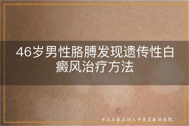 46岁男性遗传性白癜风治疗方法, 白癜风药物治疗, 白癜风光疗手术, 白癜风心理治疗