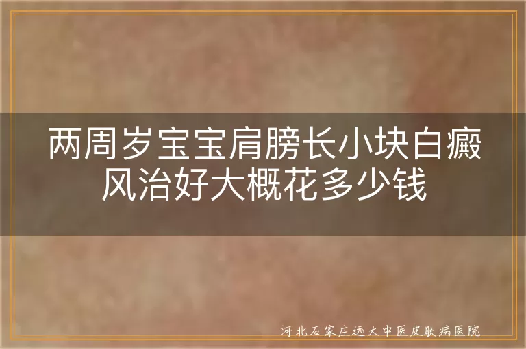 宝宝白癜风治疗费用,小块白斑治疗费用预估,白癜风治疗经济负担,儿童白斑治疗花费